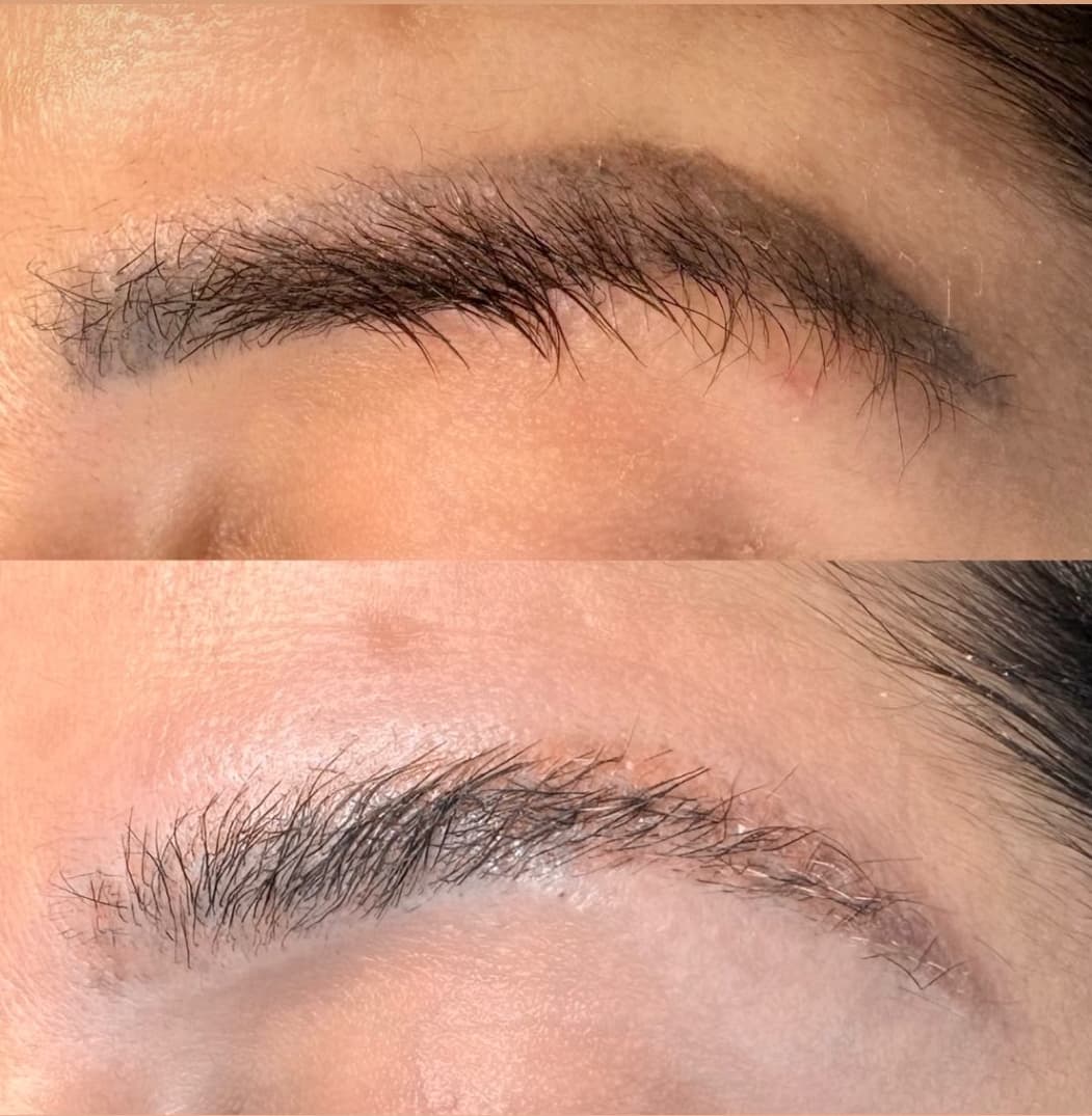 Remoção a Laser ND YAG