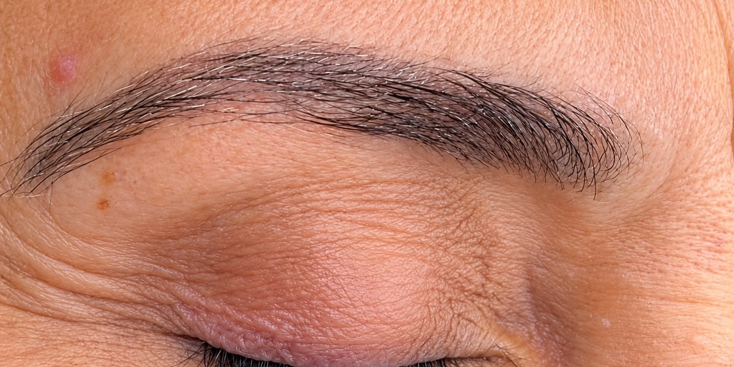 Remoção a Laser ND YAG: resultado depois da micropigmentação