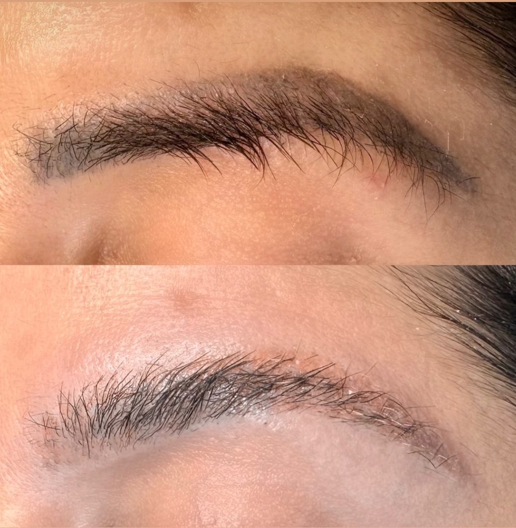 Remoção a Laser ND YAG: resultado de micropigmentação por Judy Mascarenhas